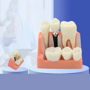 1 סט של שיניים ללמד ניתוח שתל כתר גשר נשלף דגם שיניים הפגנה שיניים המודל